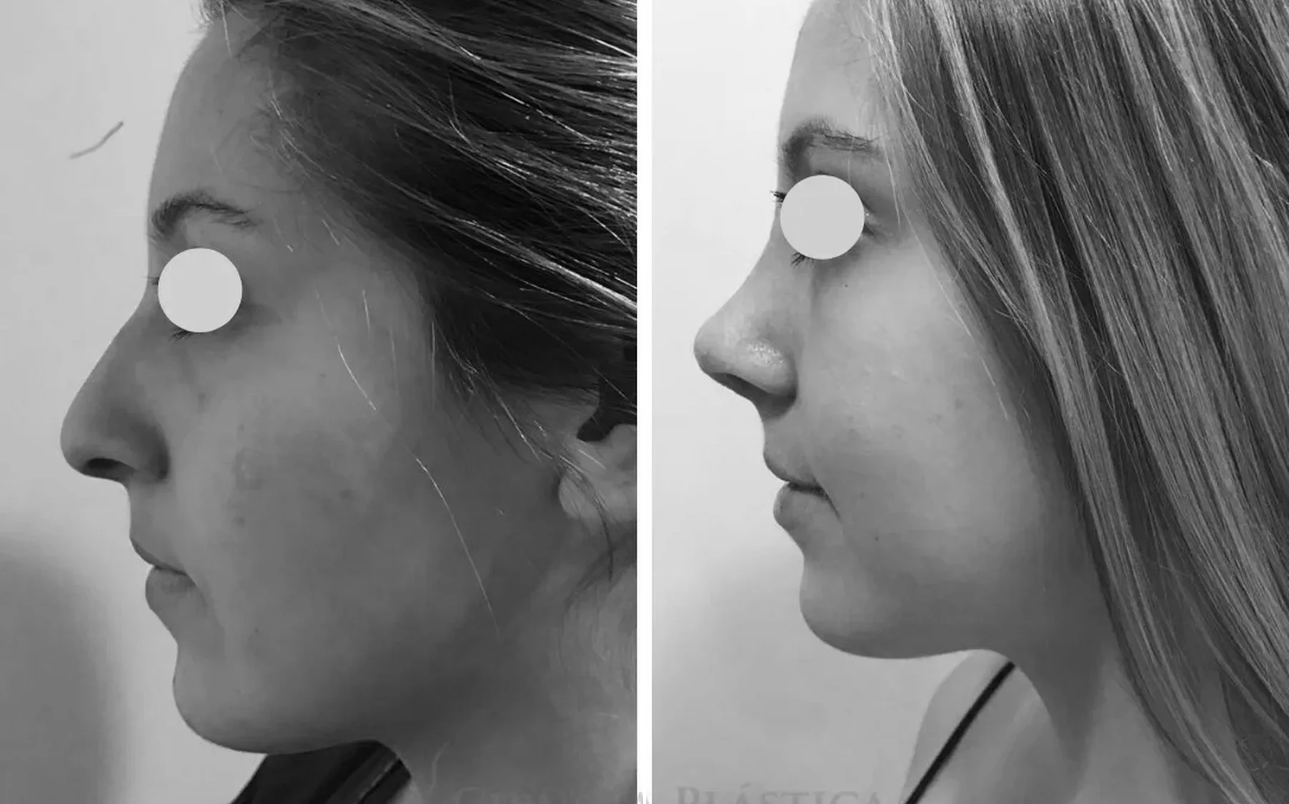 Antes y despues de un paciente operado por el Dr. Rodrigo Pinto, publicado con su autorizacion