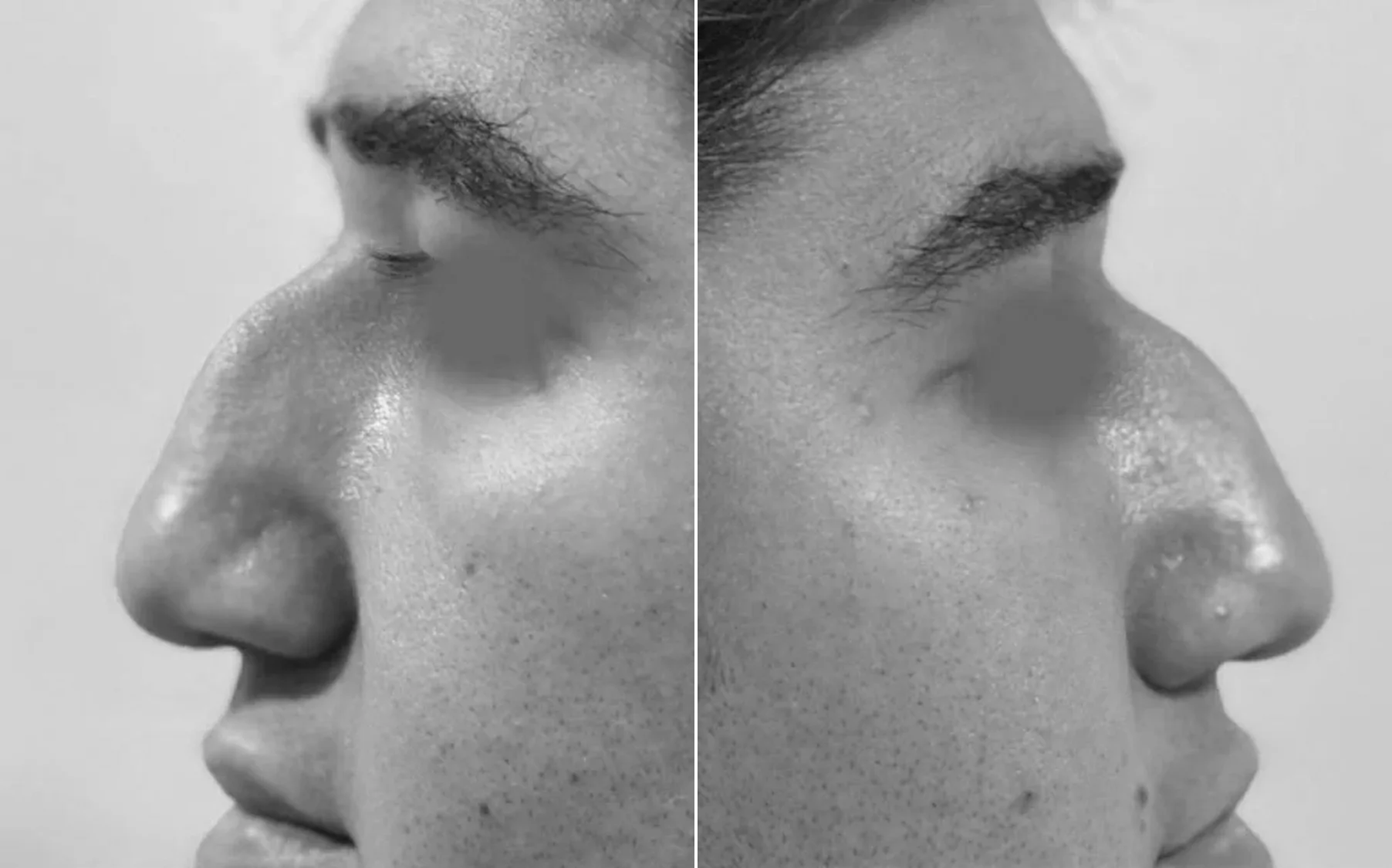 Antes y despues de un paciente operado por el Dr. Rodrigo Pinto, publicado con su autorizacion
