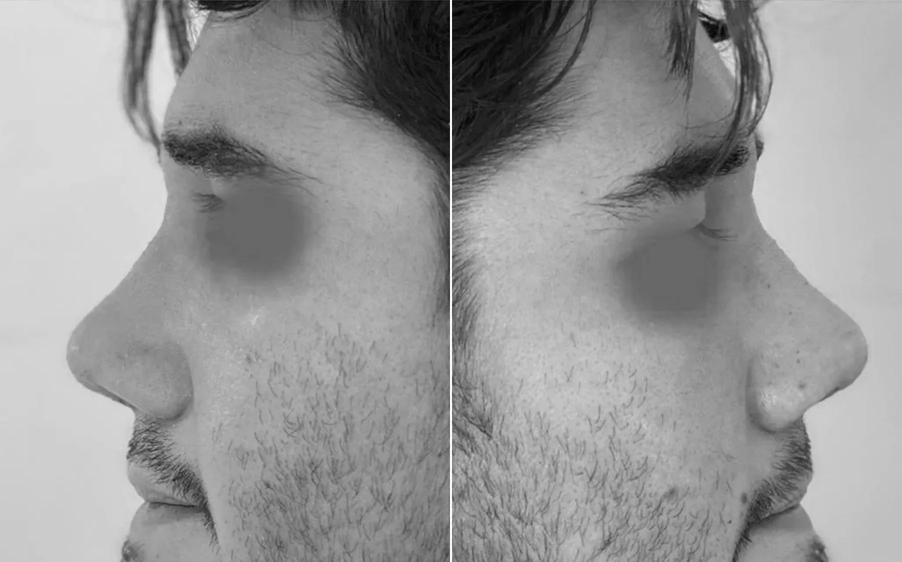 Antes y despues de un paciente operado por el Dr. Rodrigo Pinto, publicado con su autorizacion