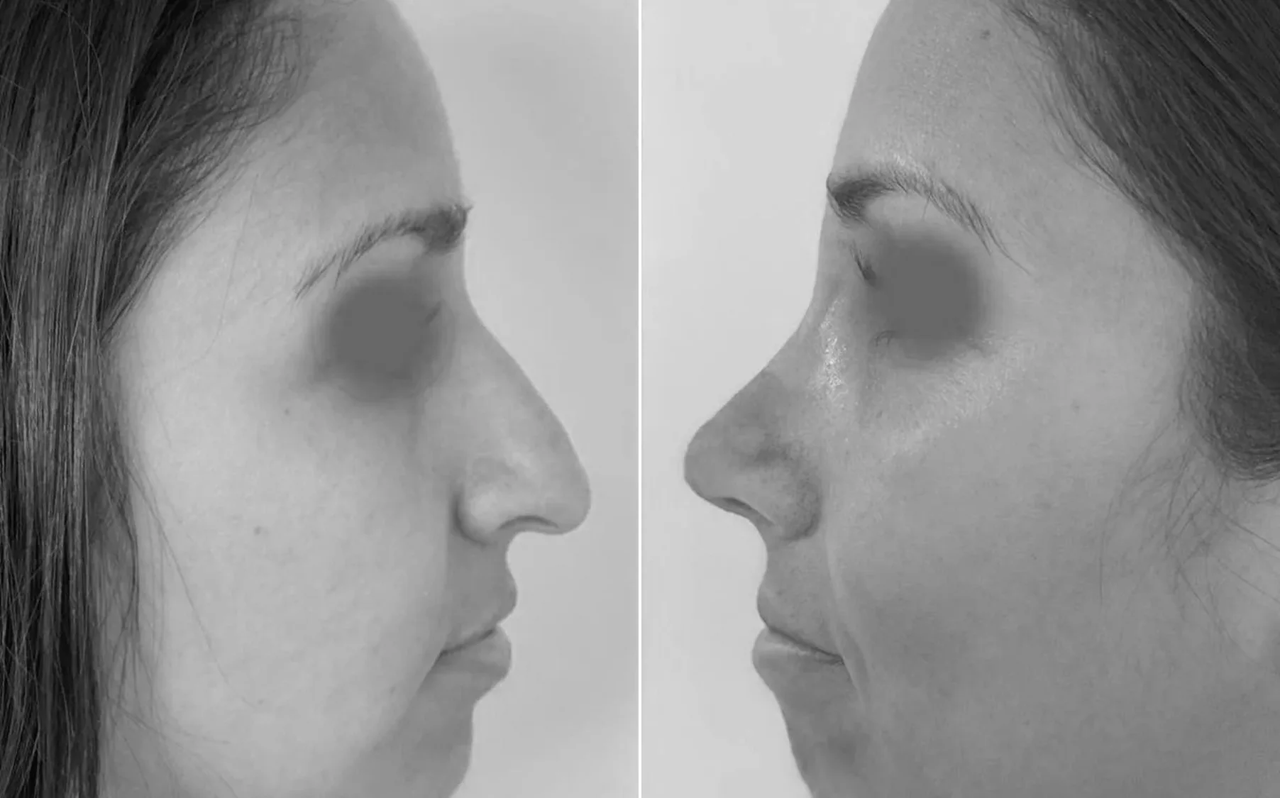 Antes y despues de un paciente operado por el Dr. Rodrigo Pinto, publicado con su autorizacion