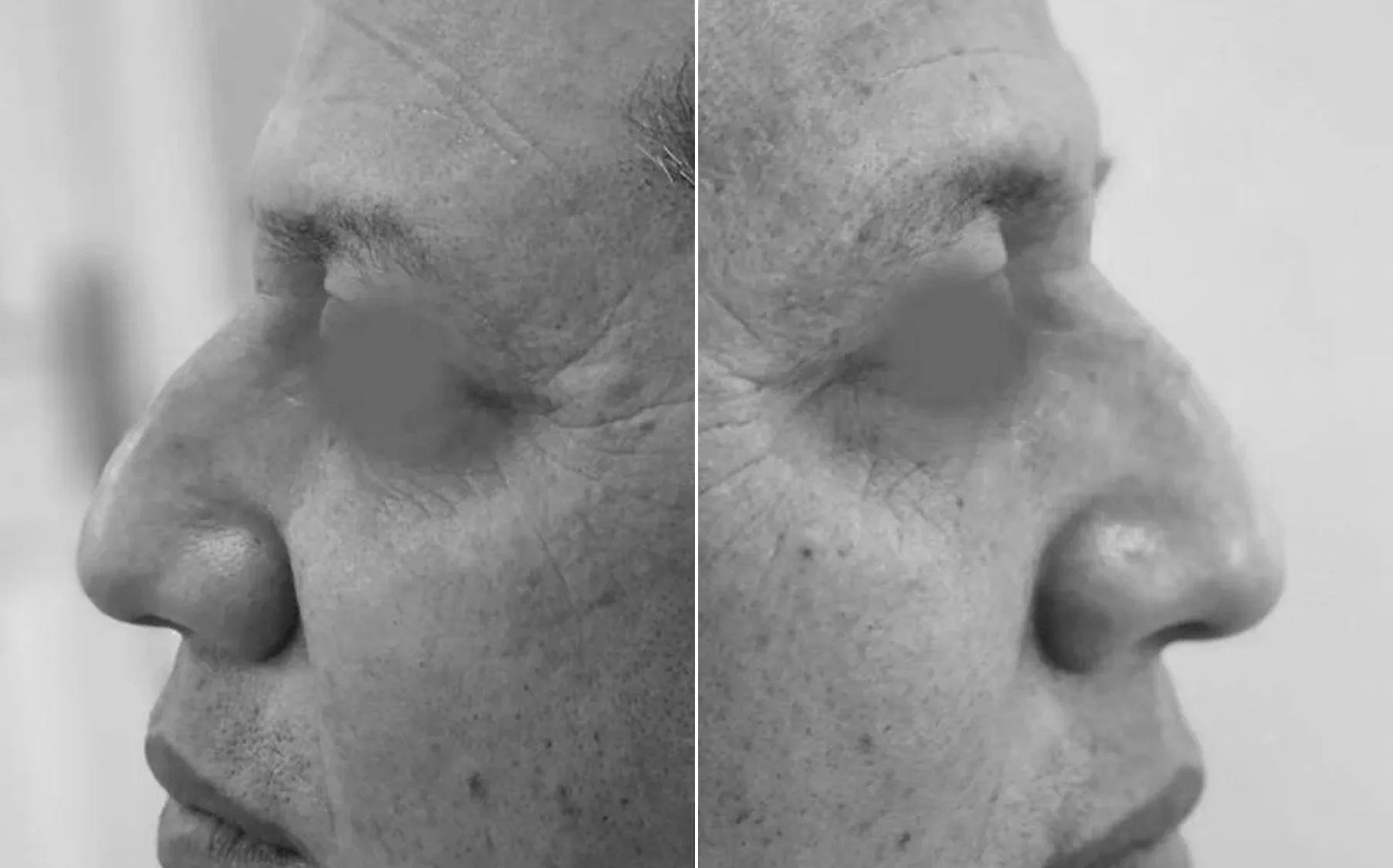 Antes y despues de un paciente operado por el Dr. Rodrigo Pinto, publicado con su autorizacion