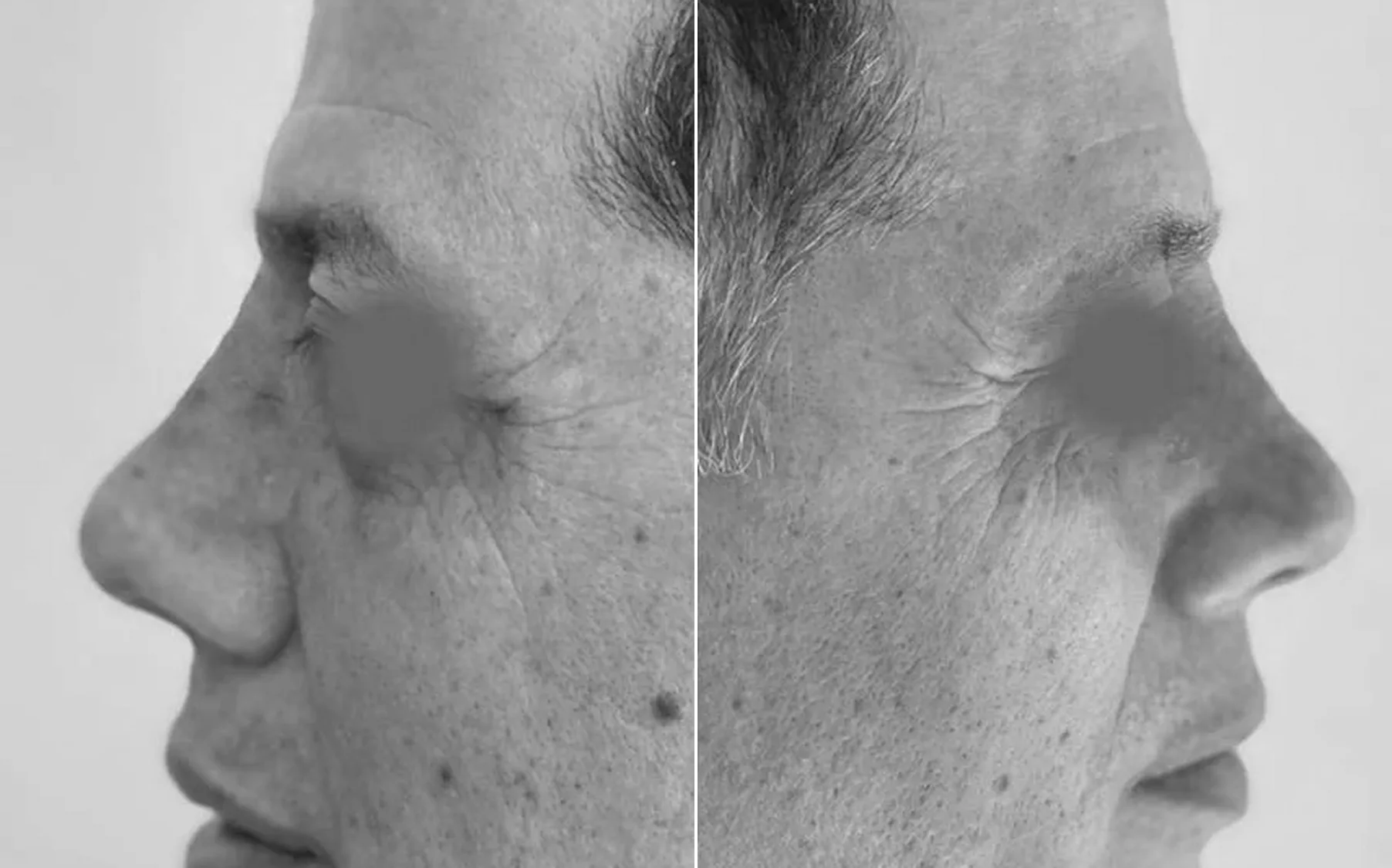 Antes y despues de un paciente operado por el Dr. Rodrigo Pinto, publicado con su autorizacion