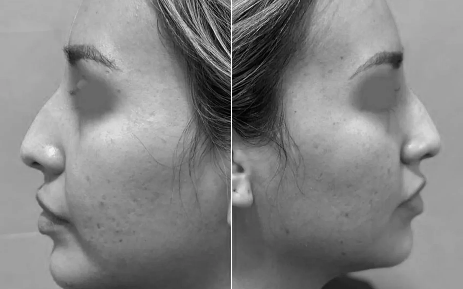 Antes y despues de un paciente operado por el Dr. Rodrigo Pinto, publicado con su autorizacion