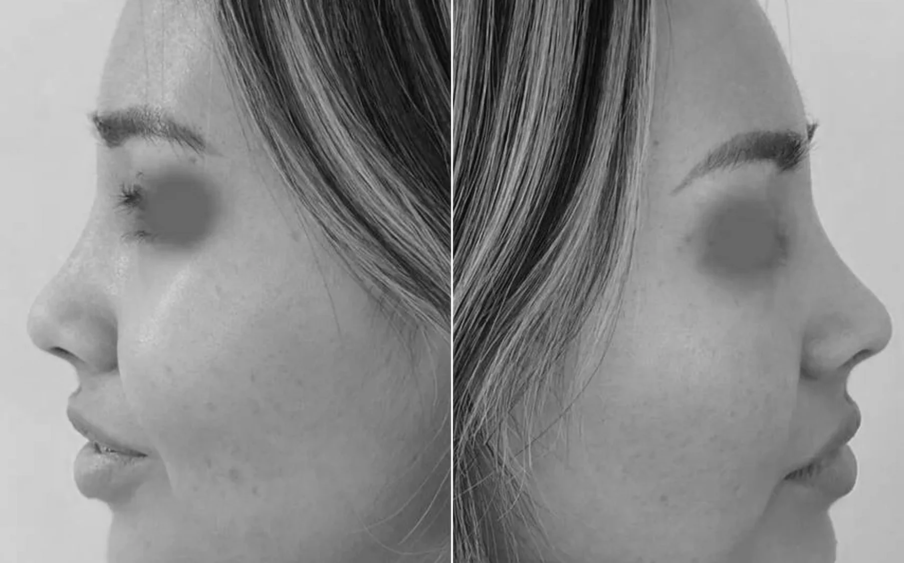 Antes y despues de un paciente operado por el Dr. Rodrigo Pinto, publicado con su autorizacion