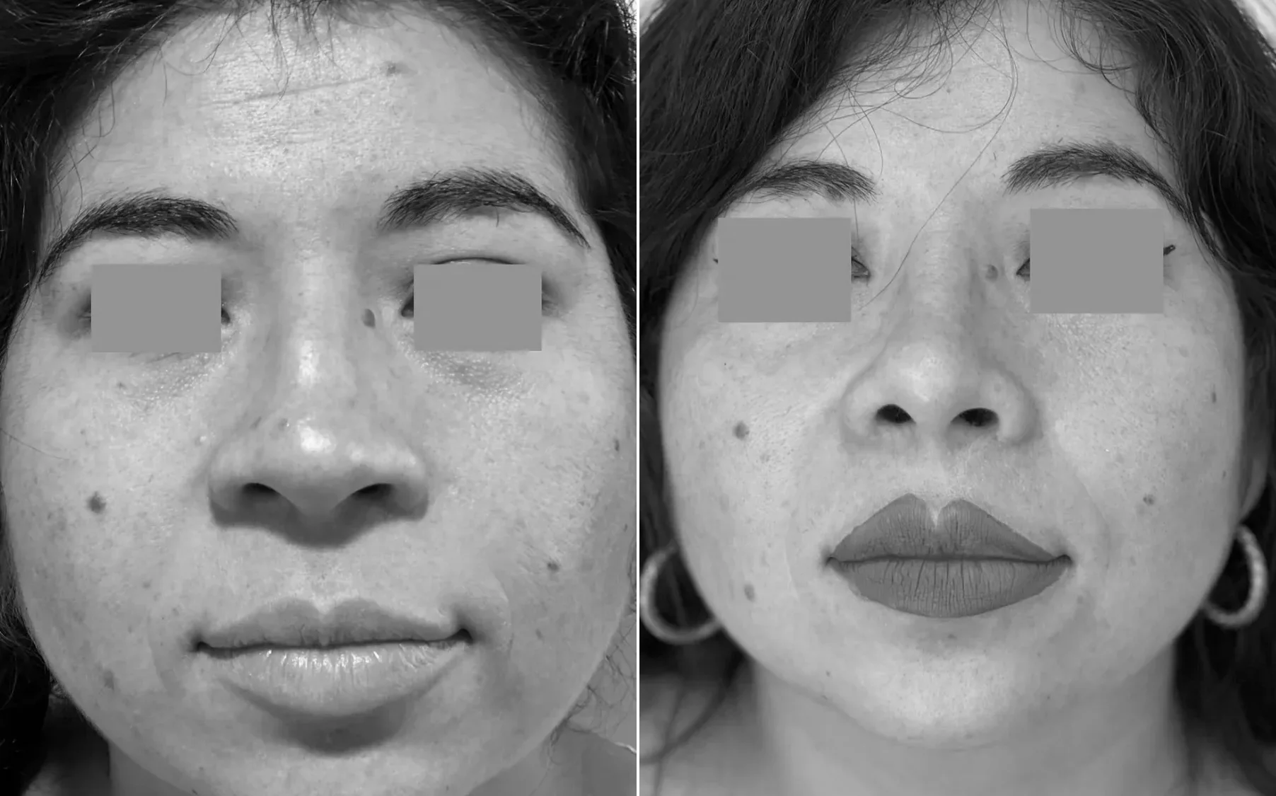 Antes y despues de un paciente operado por el Dr. Rodrigo Pinto, publicado con su autorizacion
