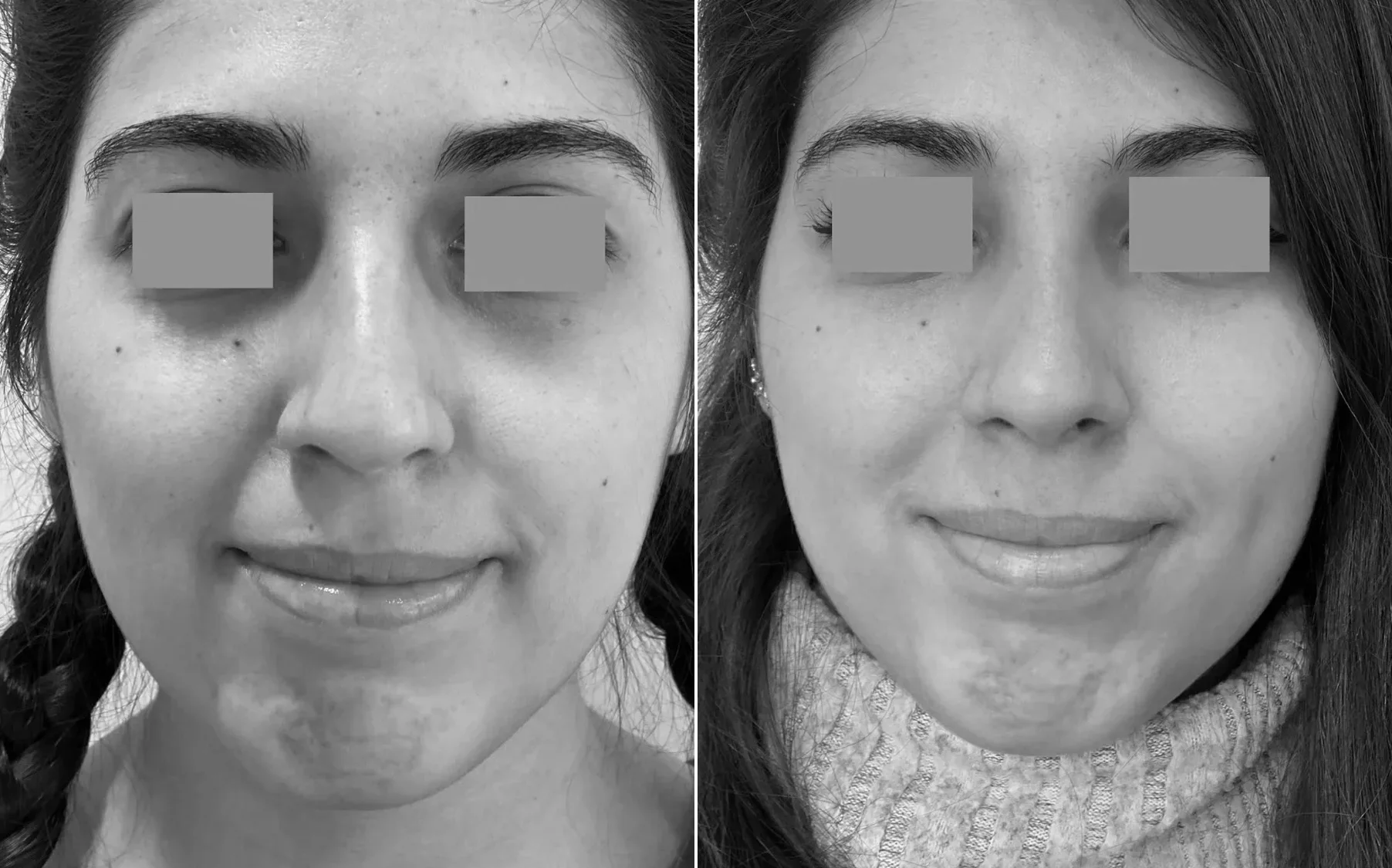 Antes y despues de un paciente operado por el Dr. Rodrigo Pinto, publicado con su autorizacion