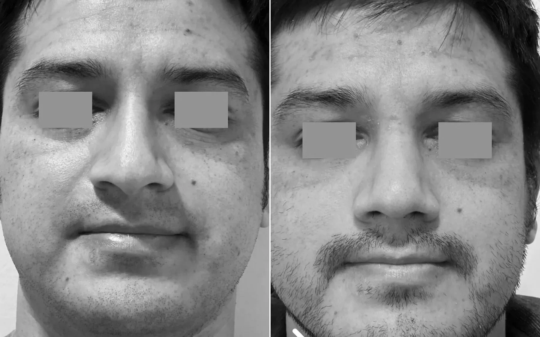 Antes y despues de un paciente operado por el Dr. Rodrigo Pinto, publicado con su autorizacion