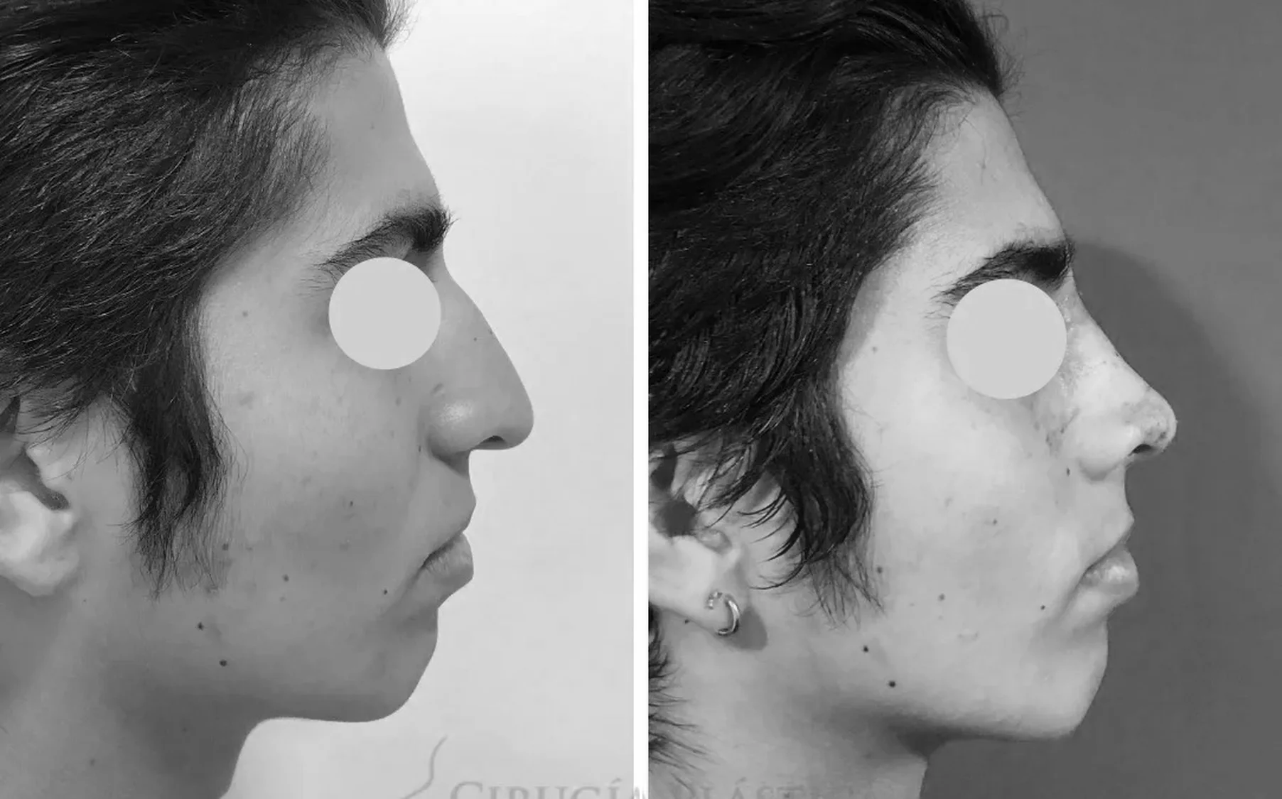 Antes y despues de un paciente operado por el Dr. Rodrigo Pinto, publicado con su autorizacion
