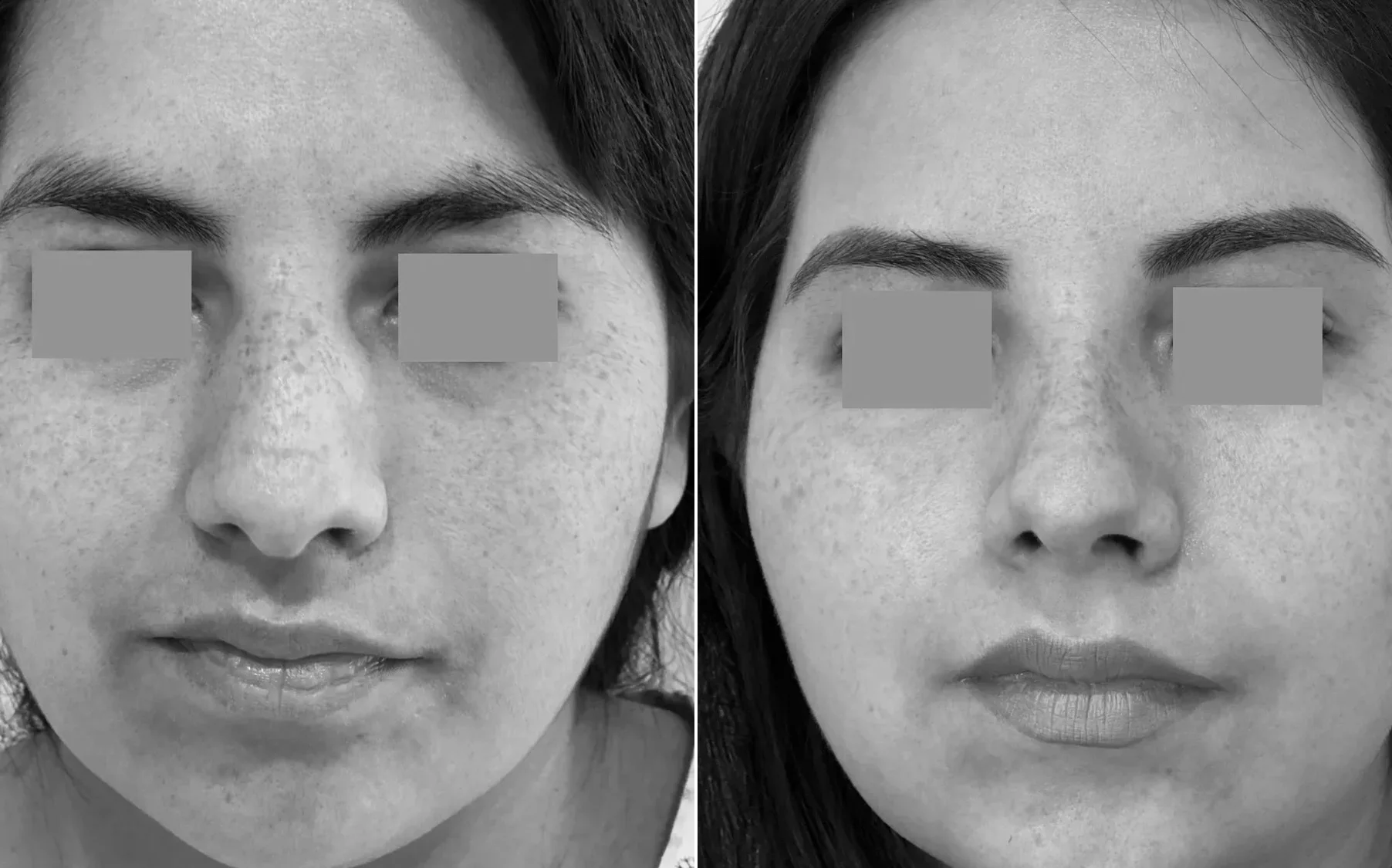 Antes y despues de un paciente operado por el Dr. Rodrigo Pinto, publicado con su autorizacion