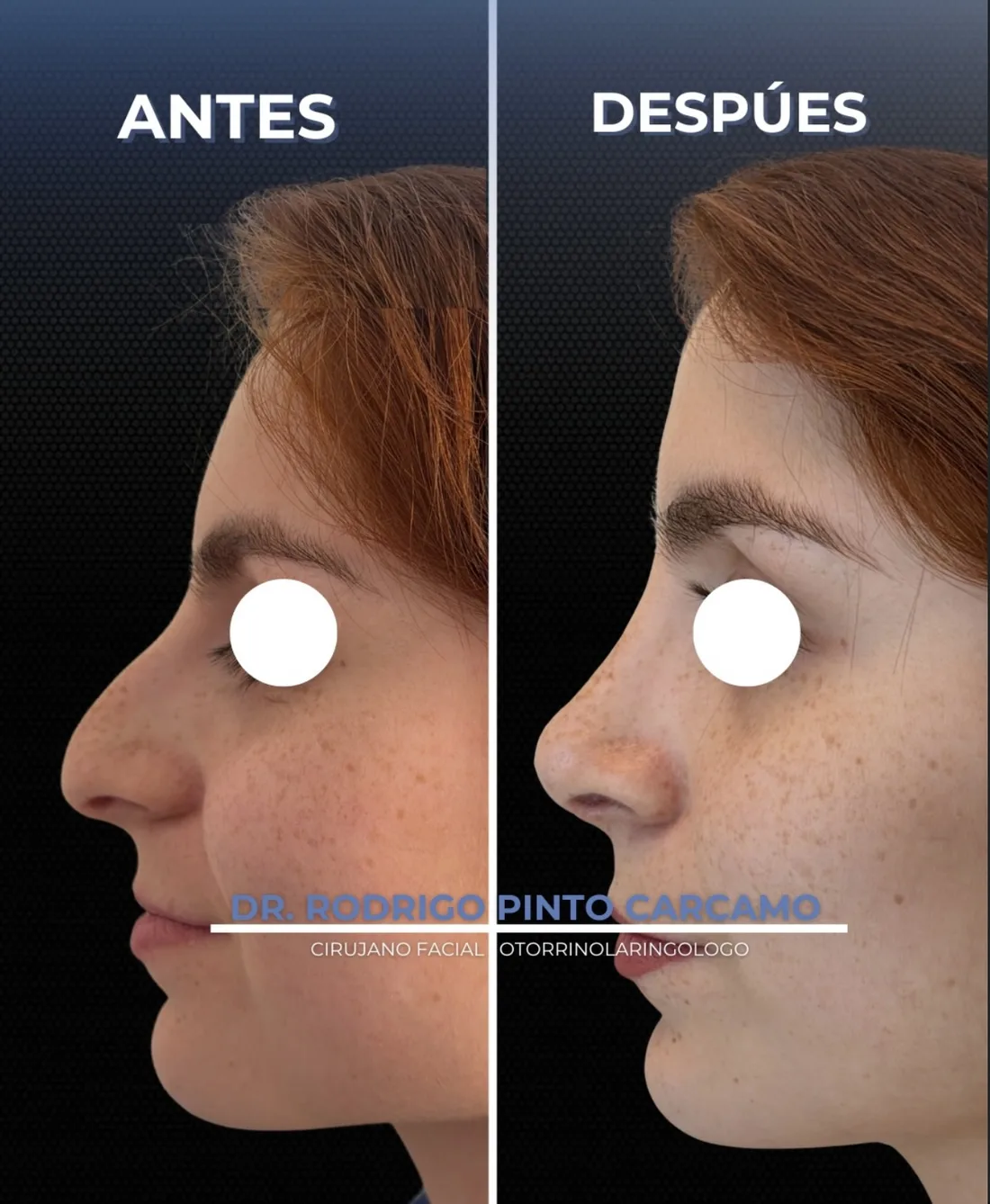 Antes y despues de un paciente operado por el Dr. Rodrigo Pinto, publicado con su autorizacion