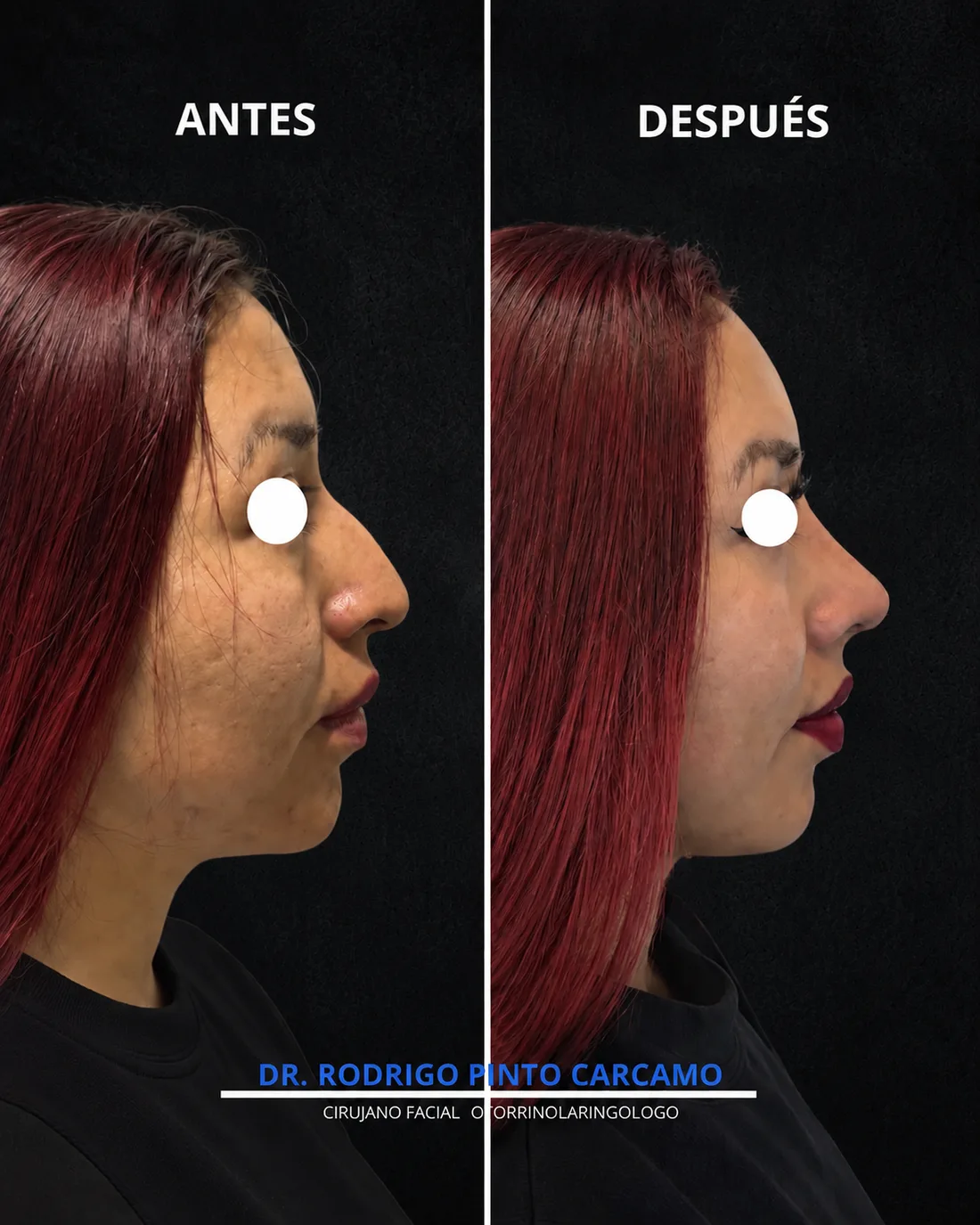 Antes y despues de un paciente operado por el Dr. Rodrigo Pinto, publicado con su autorizacion