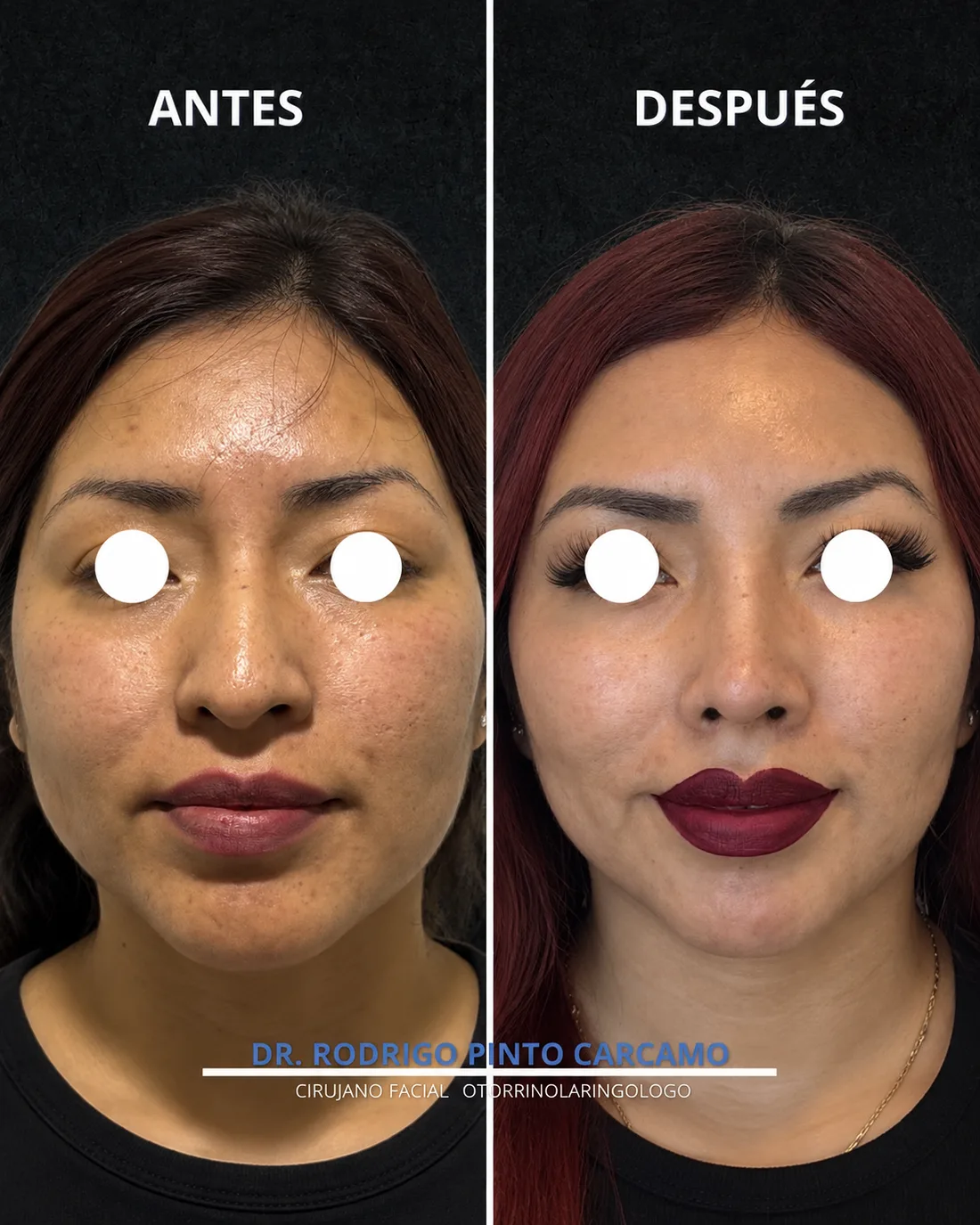 Antes y despues de un paciente operado por el Dr. Rodrigo Pinto, publicado con su autorizacion