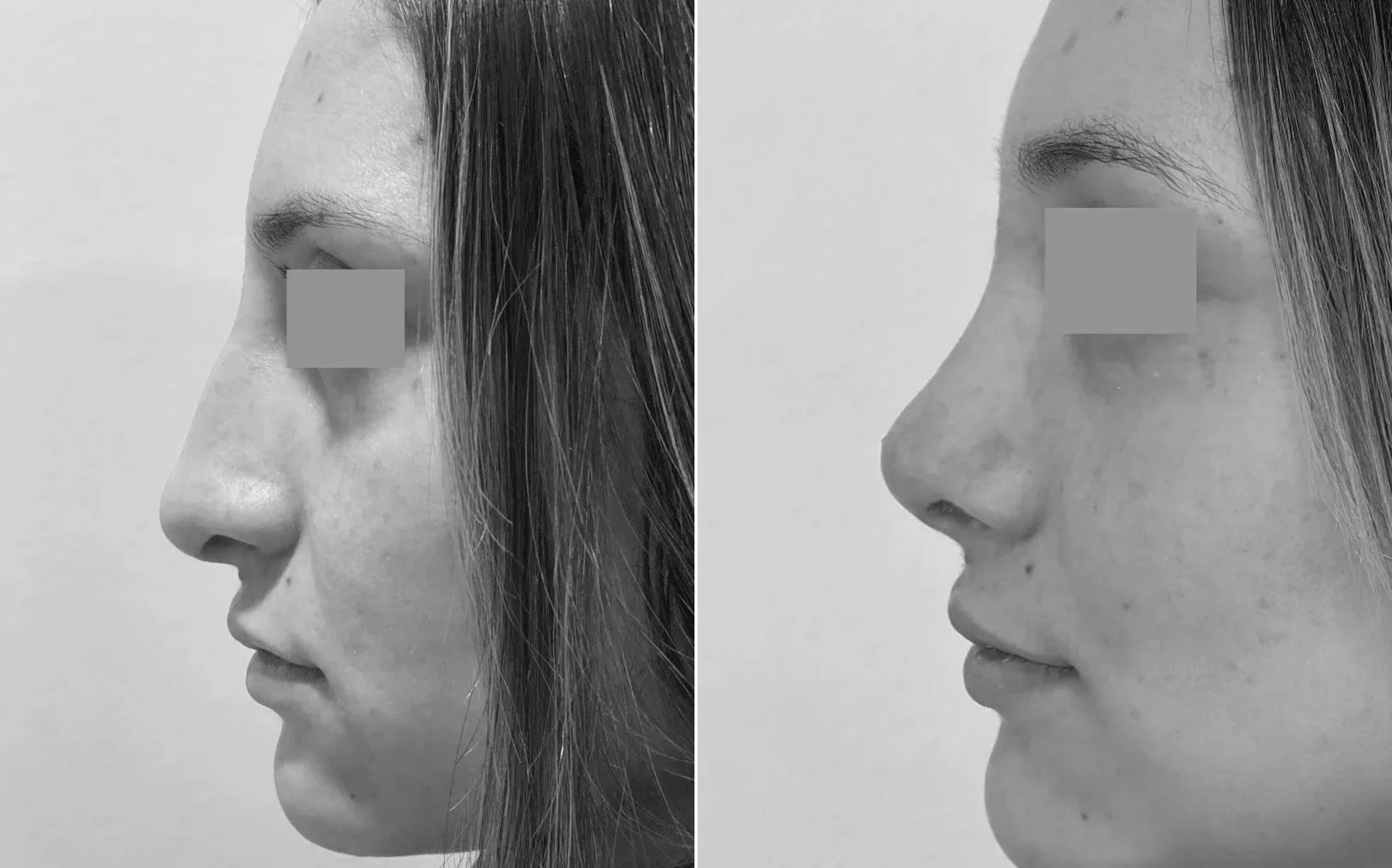 Antes y despues de un paciente operado por el Dr. Rodrigo Pinto, publicado con su autorizacion