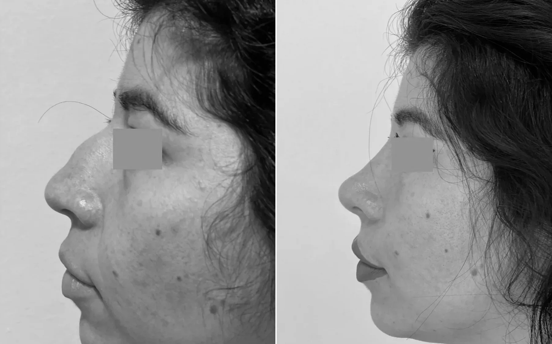 Antes y despues de un paciente operado por el Dr. Rodrigo Pinto, publicado con su autorizacion