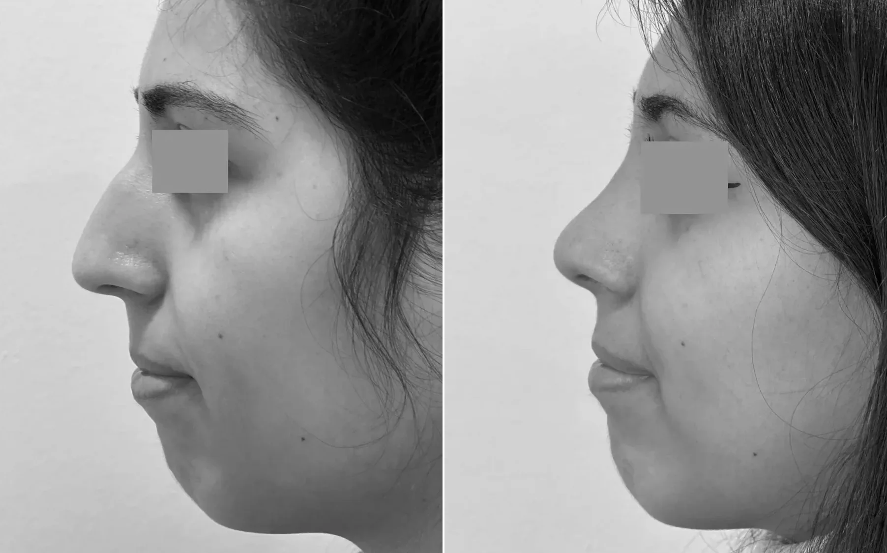 Antes y despues de un paciente operado por el Dr. Rodrigo Pinto, publicado con su autorizacion