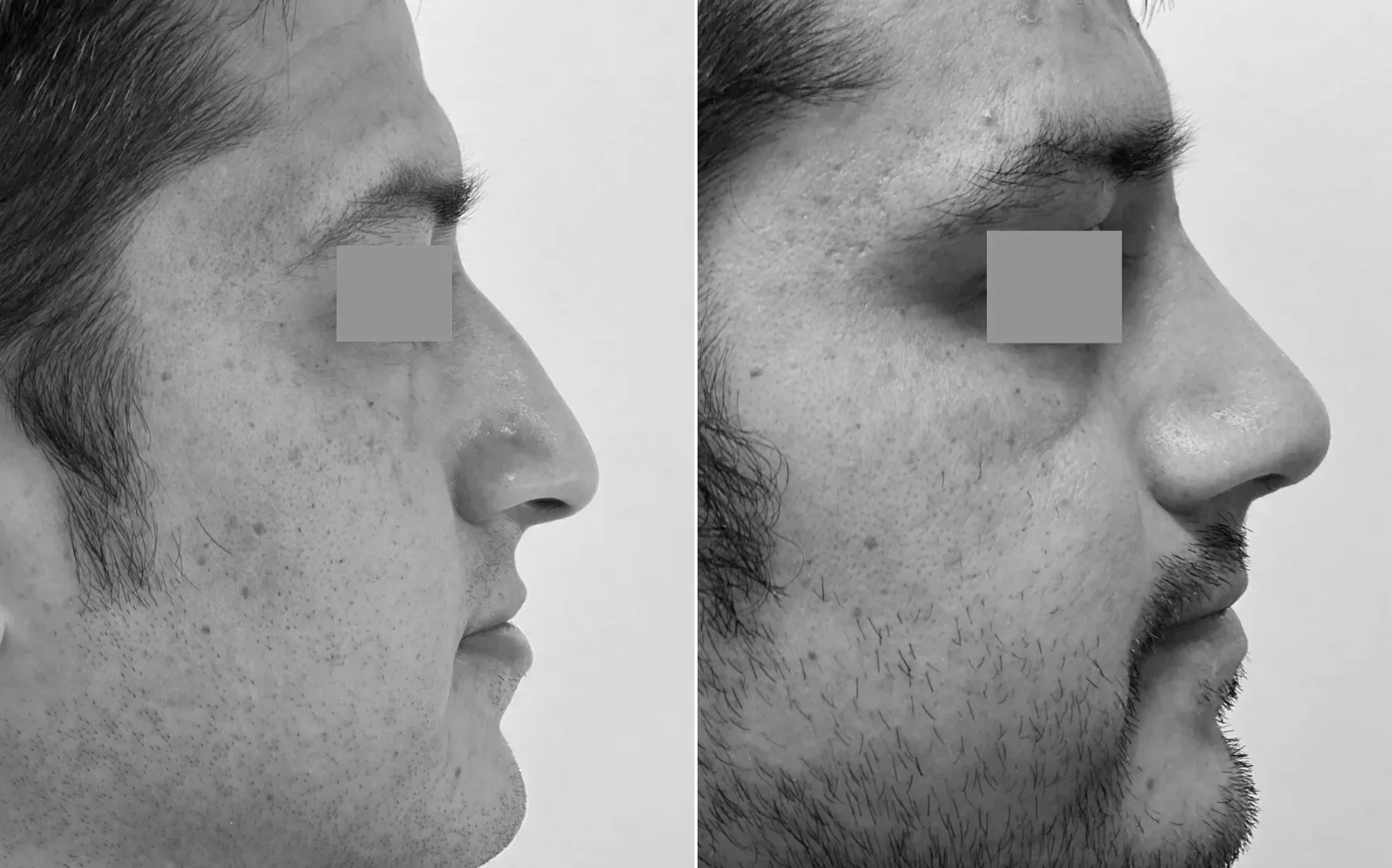 Antes y despues de un paciente operado por el Dr. Rodrigo Pinto, publicado con su autorizacion