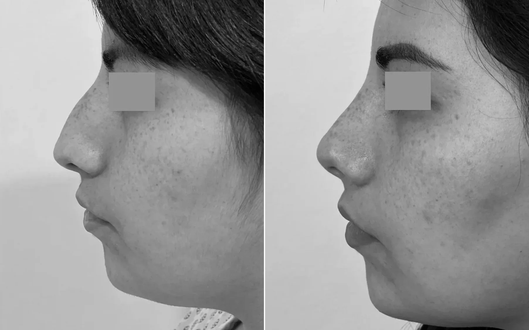 Antes y despues de un paciente operado por el Dr. Rodrigo Pinto, publicado con su autorizacion