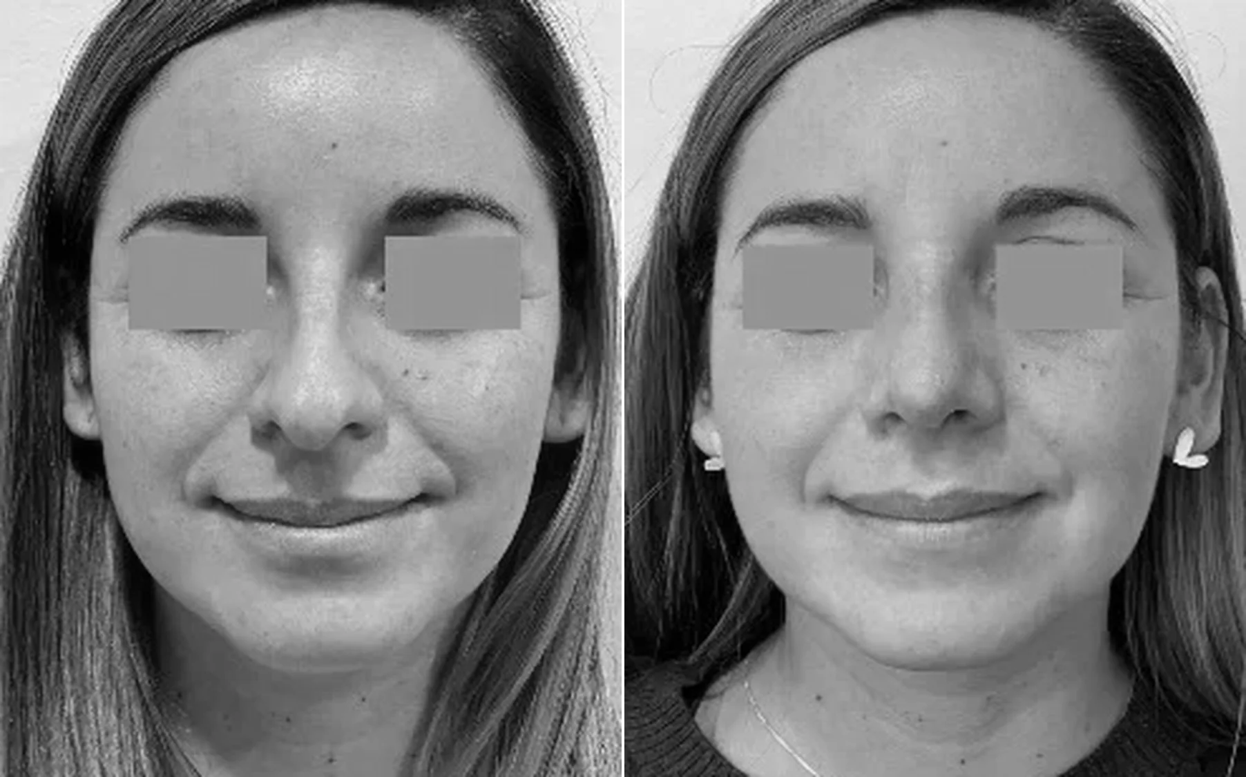 Antes y despues de un paciente operado por el Dr. Rodrigo Pinto, publicado con su autorizacion
