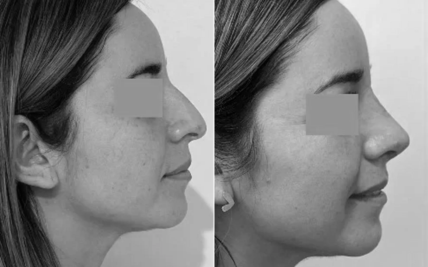 Antes y despues de un paciente operado por el Dr. Rodrigo Pinto, publicado con su autorizacion