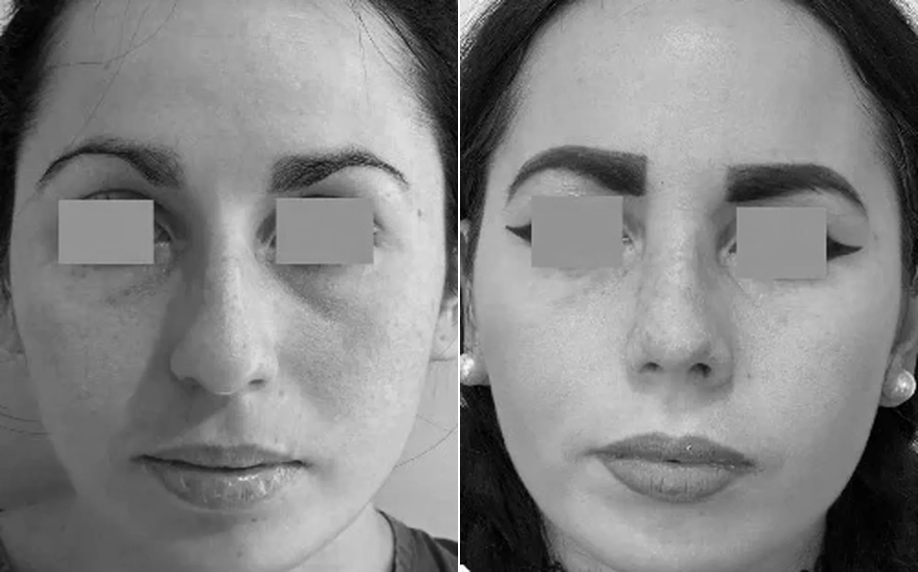 Antes y despues de un paciente operado por el Dr. Rodrigo Pinto, publicado con su autorizacion