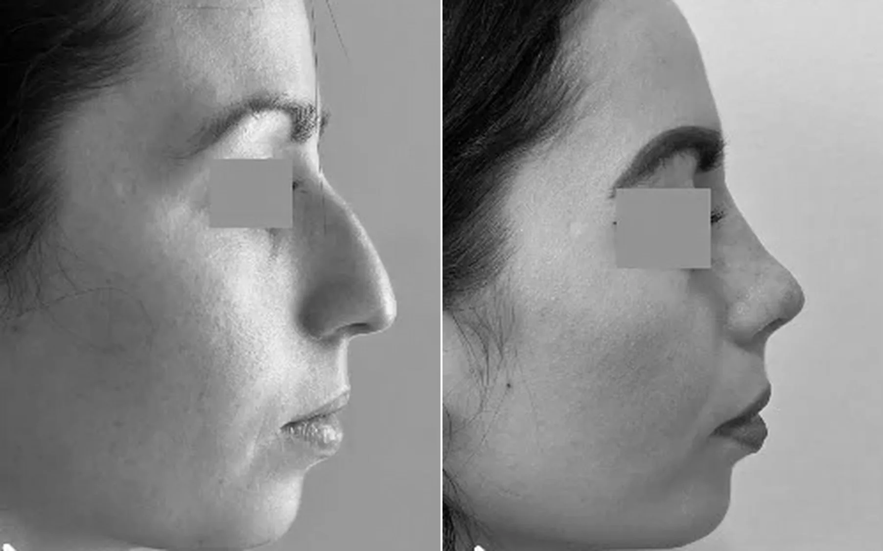 Antes y despues de un paciente operado por el Dr. Rodrigo Pinto, publicado con su autorizacion