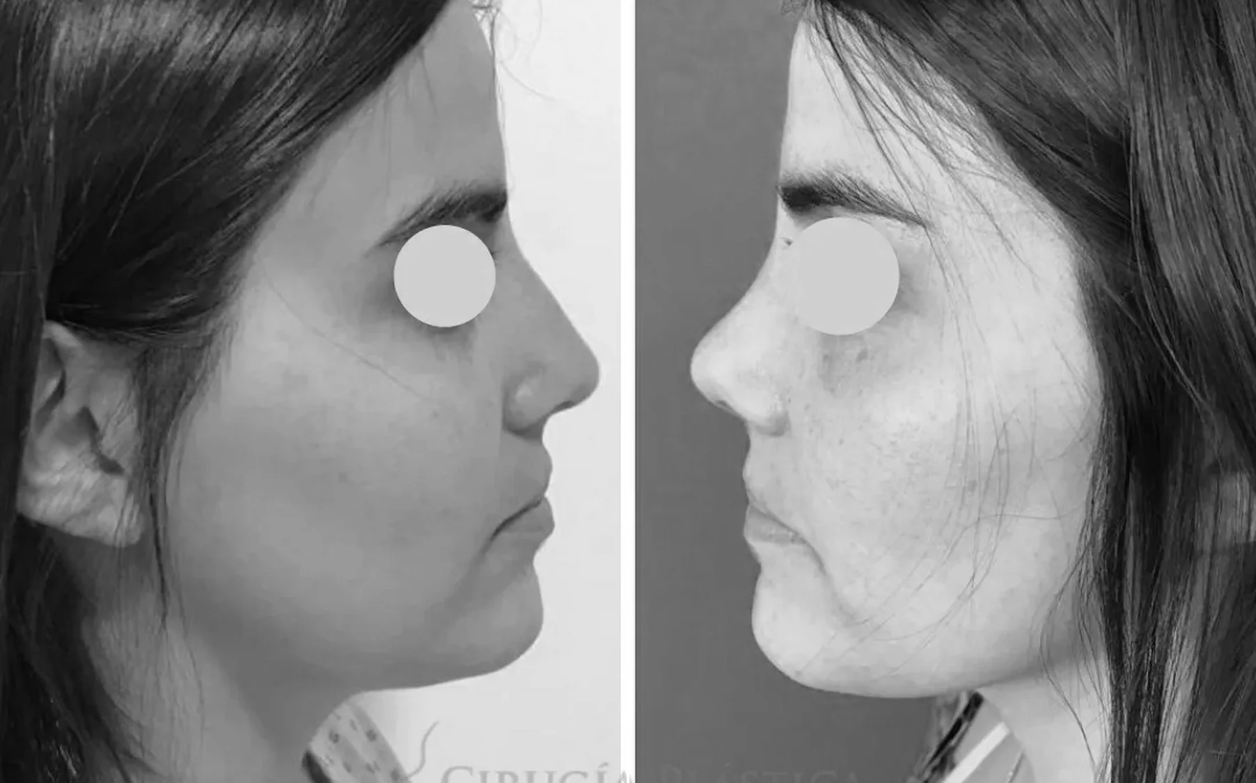 Antes y despues de un paciente operado por el Dr. Rodrigo Pinto, publicado con su autorizacion