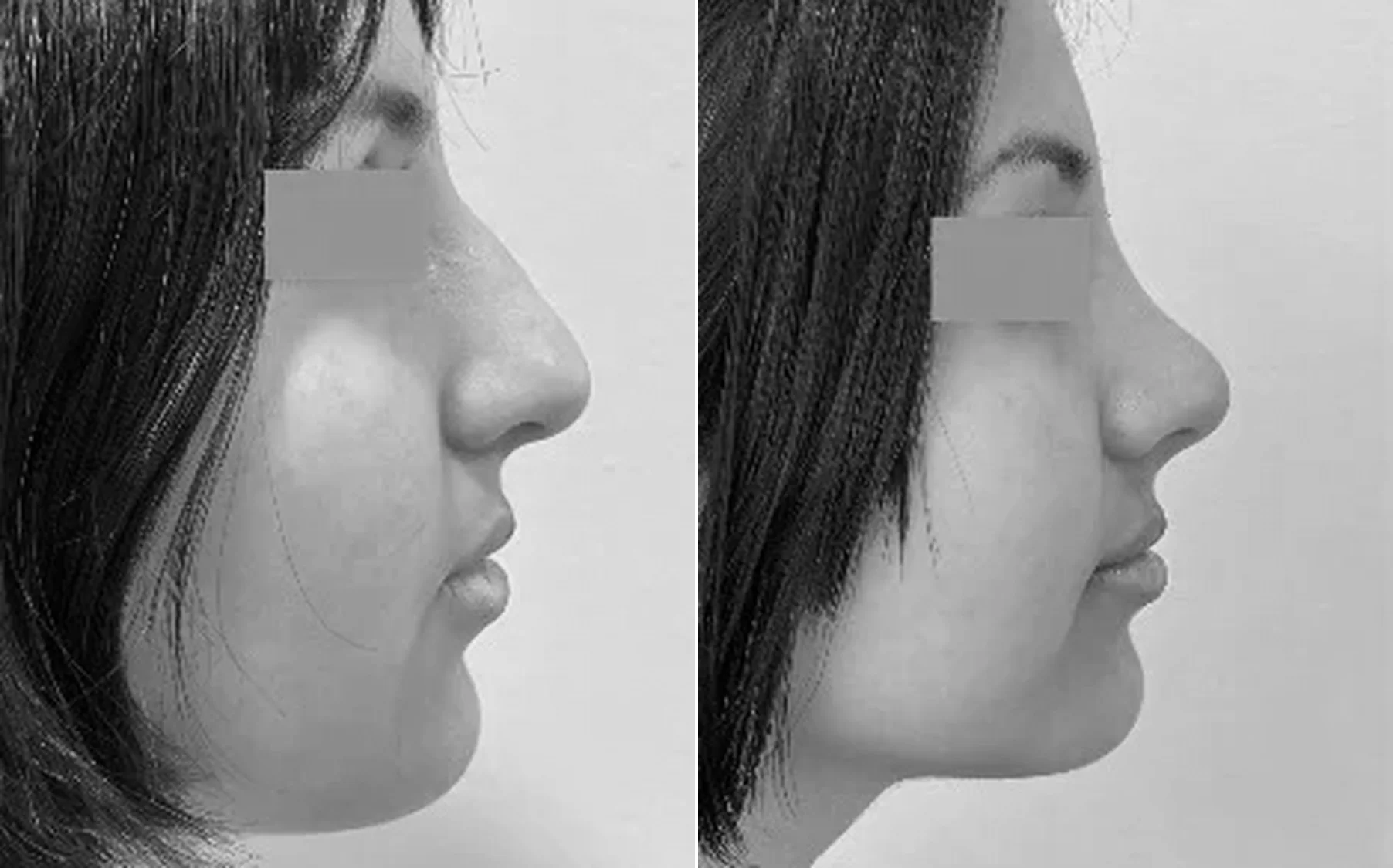 Antes y despues de un paciente operado por el Dr. Rodrigo Pinto, publicado con su autorizacion