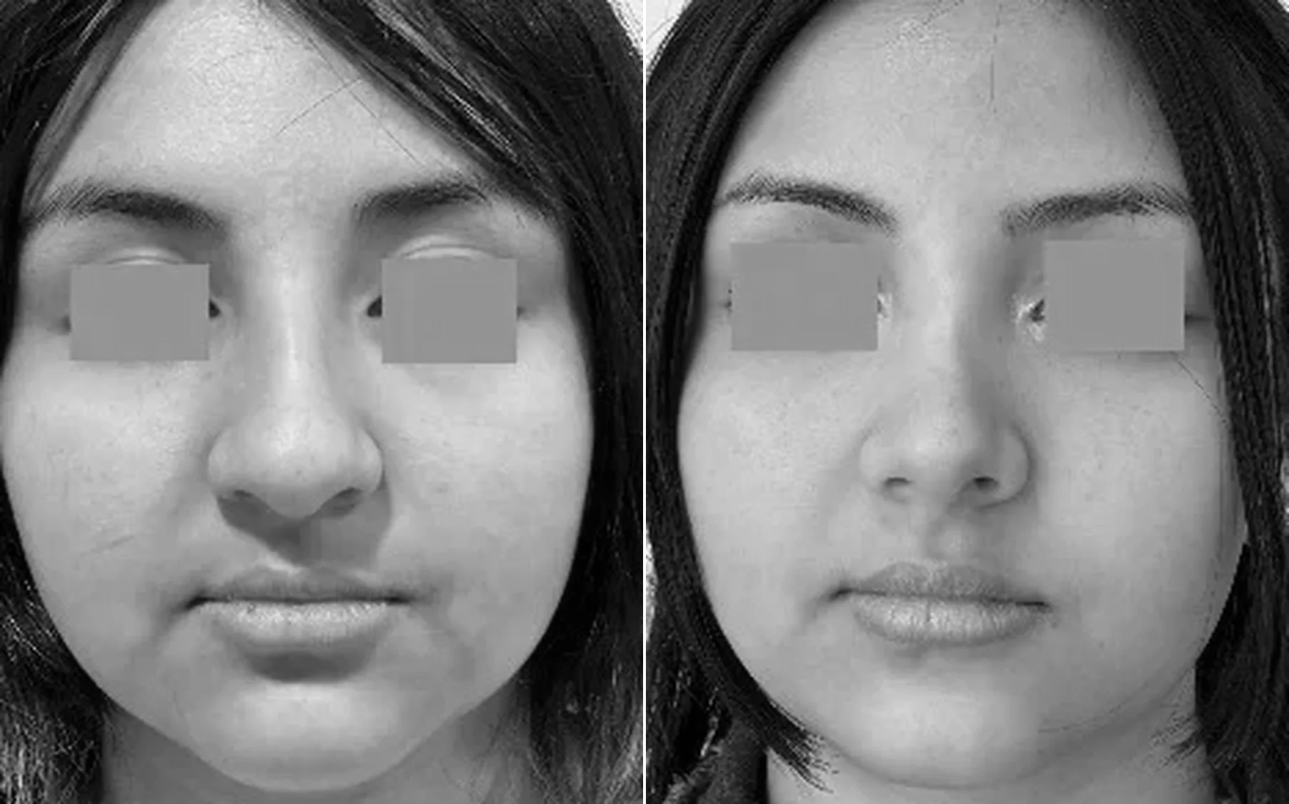 Antes y despues de un paciente operado por el Dr. Rodrigo Pinto, publicado con su autorizacion