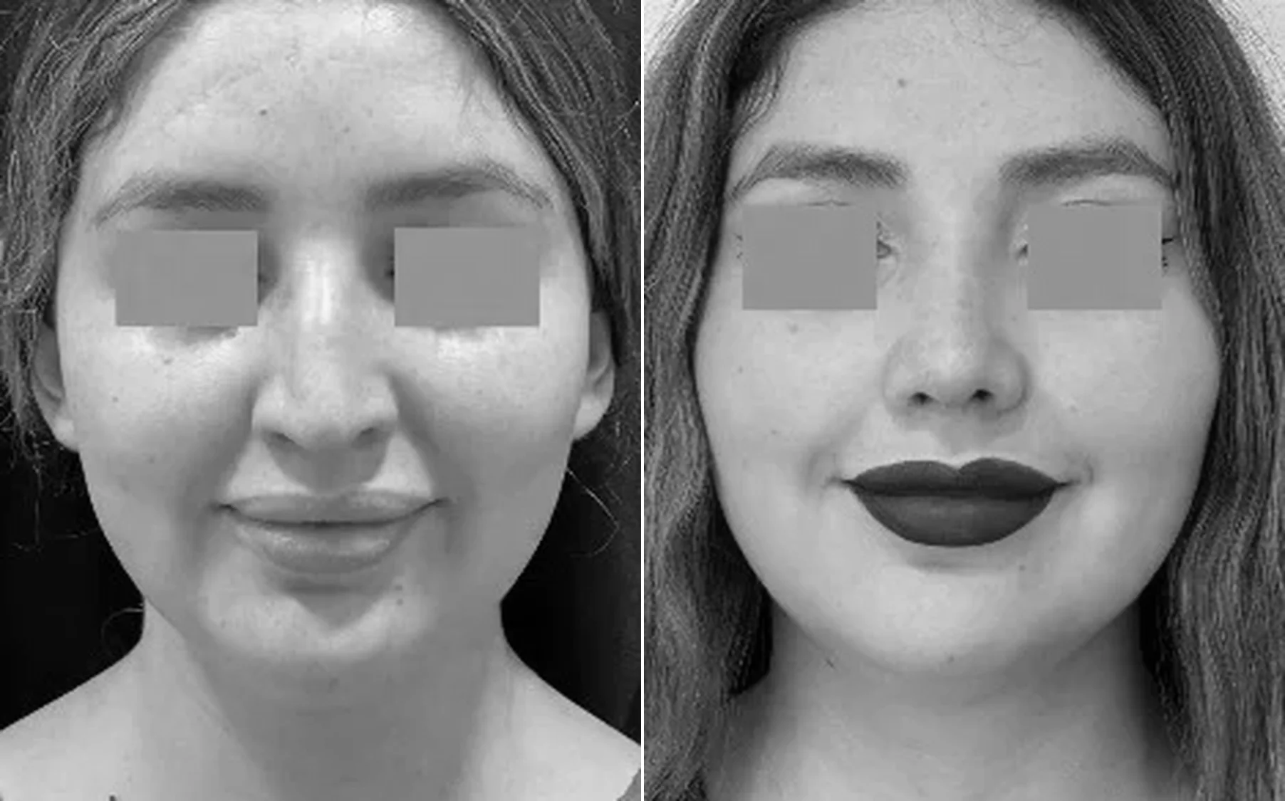 Antes y despues de un paciente operado por el Dr. Rodrigo Pinto, publicado con su autorizacion