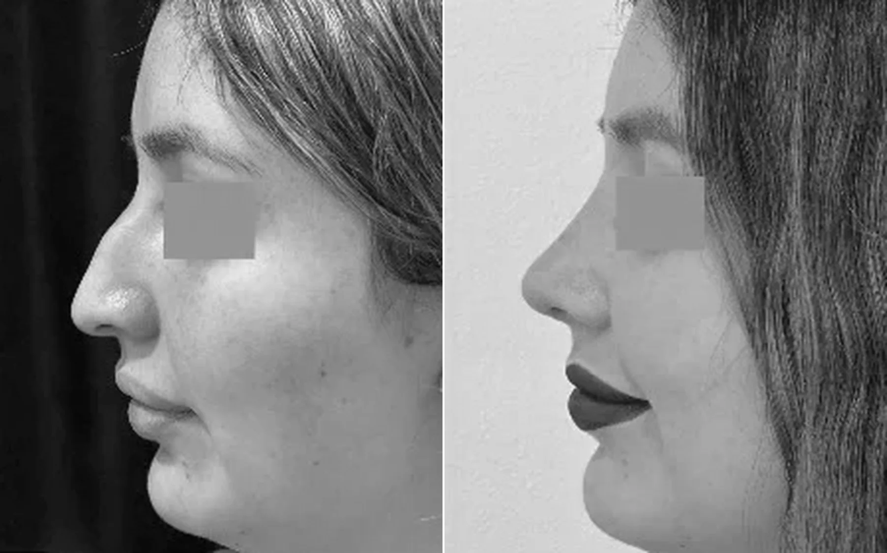 Antes y despues de un paciente operado por el Dr. Rodrigo Pinto, publicado con su autorizacion