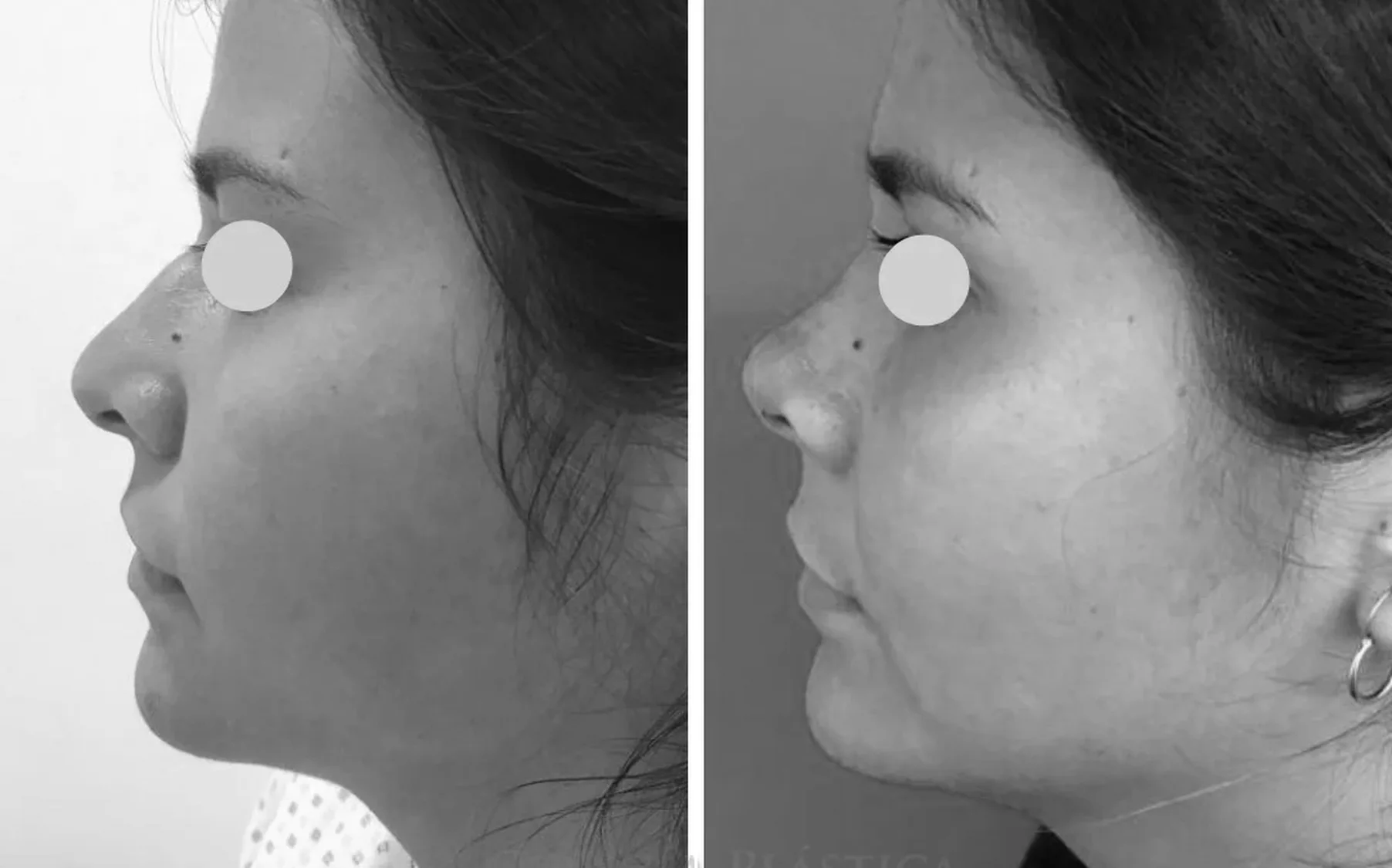 Antes y despues de un paciente operado por el Dr. Rodrigo Pinto, publicado con su autorizacion