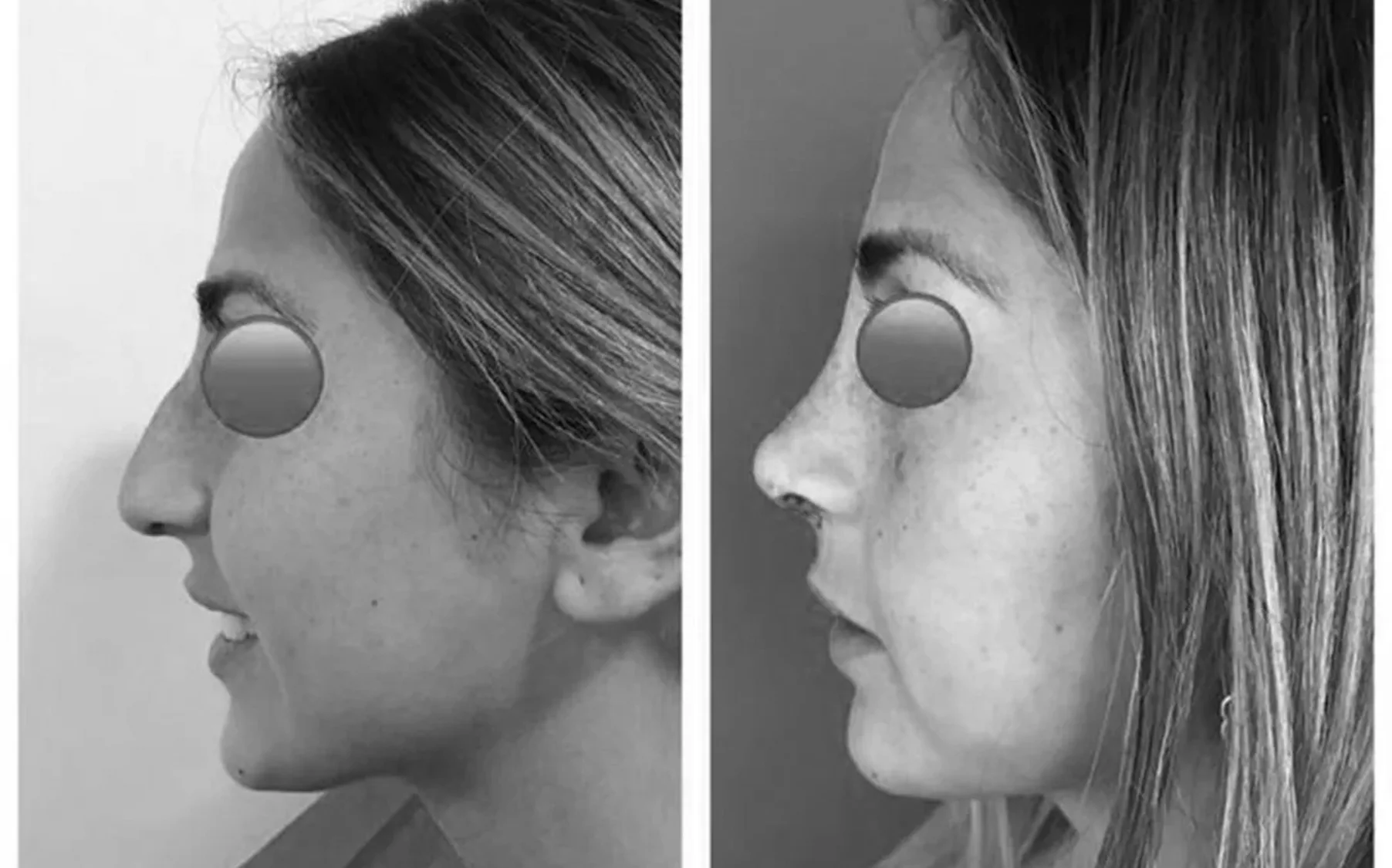Antes y despues de un paciente operado por el Dr. Rodrigo Pinto, publicado con su autorizacion