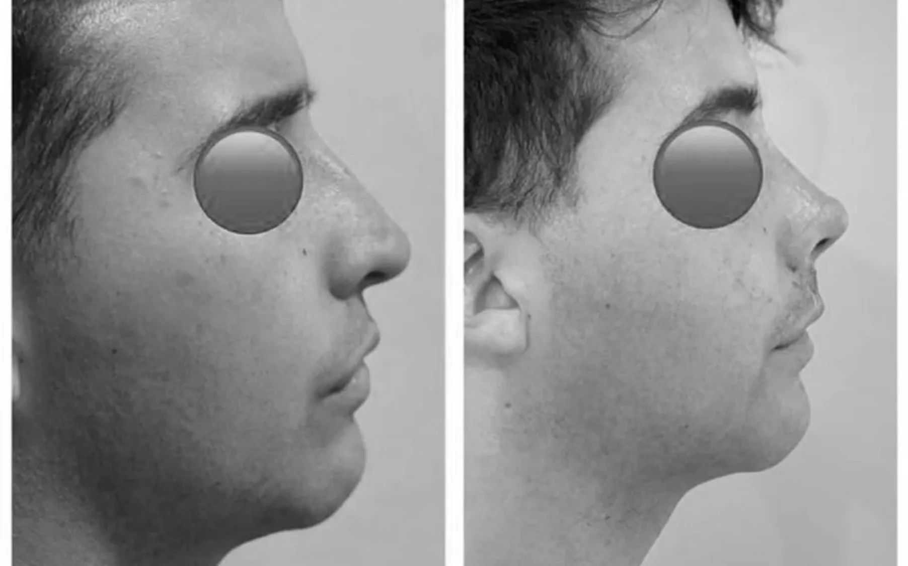 Antes y despues de un paciente operado por el Dr. Rodrigo Pinto, publicado con su autorizacion