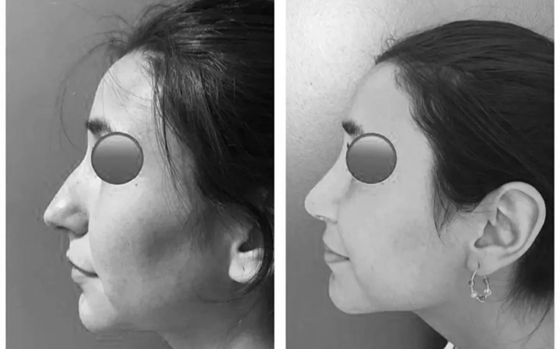 Antes y despues de un paciente operado por el Dr. Rodrigo Pinto, publicado con su autorizacion
