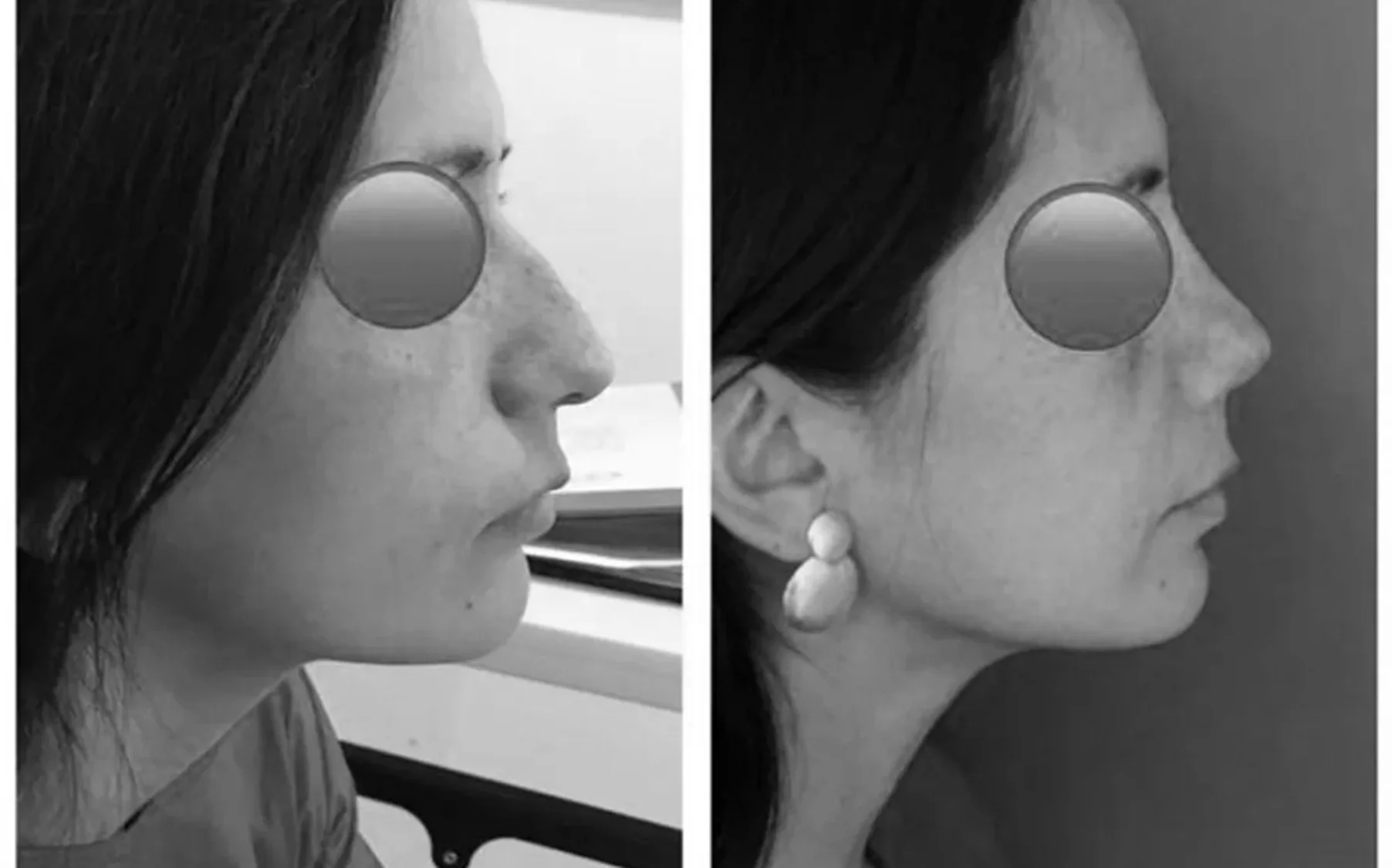 Antes y despues de un paciente operado por el Dr. Rodrigo Pinto, publicado con su autorizacion